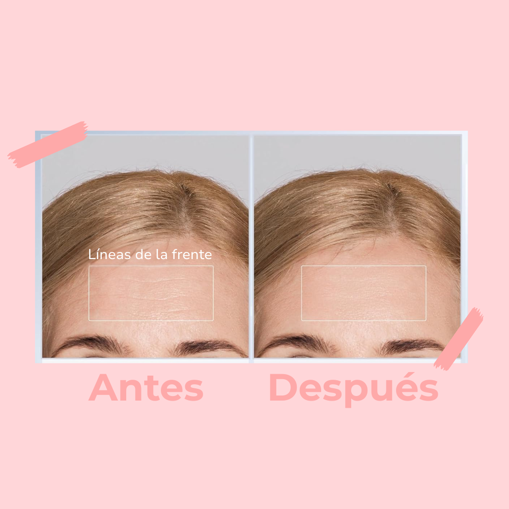 Máscara Anti-Acné de Luz LED